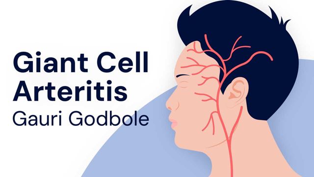 Image for Giant Cell Arteritis